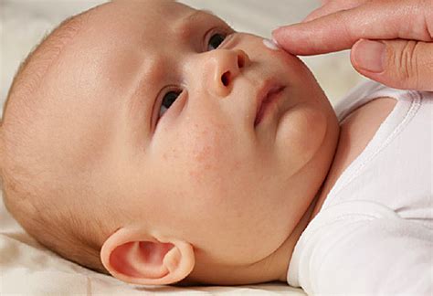 Baby Eczema - Matria - Exclusive Women and Child Hospital