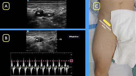Femoral Pulse Palpation Femoral Vein: Anatomy, Tributaries, Drainage