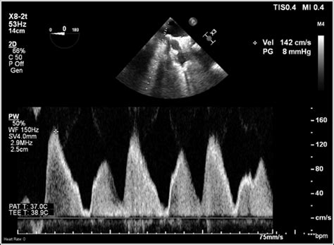 Echocardiographic Diagnosis and Management of Unexpected Pulmonary Vein ...