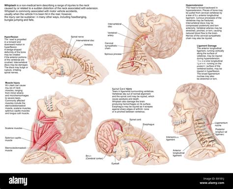 Whiplash Injury On Nerves
