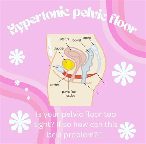 Hypertonic (Tight) Pelvic Floor : r/Endo