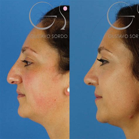 【Rinoplastia: Qué es, Tipos y Precios Guía Completa 2025】