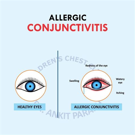 Seasonal Allergic Rhinoconjunctivitis Icd 10 at Dennis Penn blog