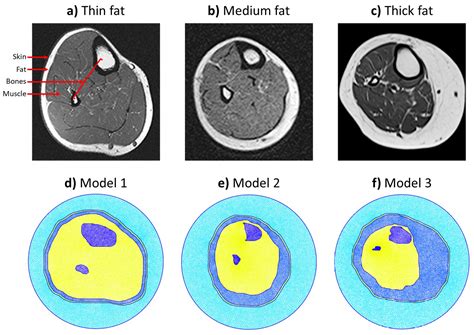 Monitoring Bone Density Using Microwave Tomography of Human Legs: A ...