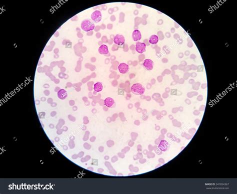 Blast Cell Blood Smear Under Microscope: foto de stock (editar ahora ...