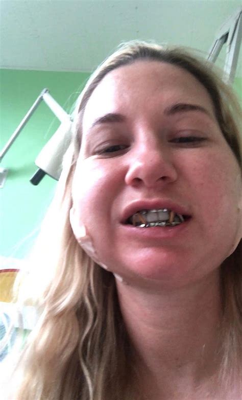 Woman struggles to eat in public after spa treatment 'left her with ...