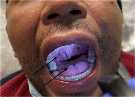 A Perplexing Purple Rash - Journal of Emergency Medicine