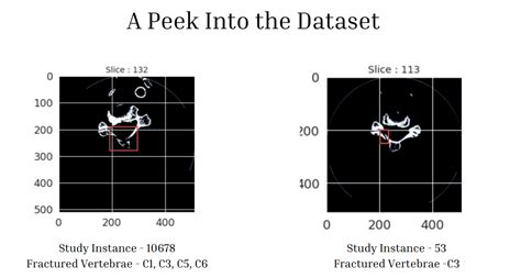 Bone Fracture Detection Using Image Processing Source Code GitHub 的图像结果