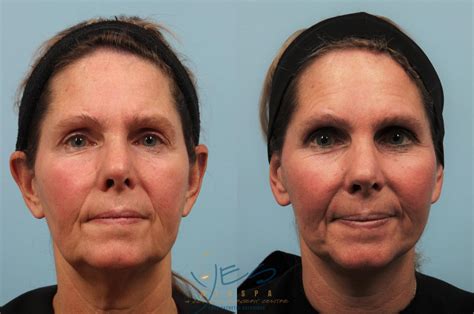 Face Lift & Neck Lift Before & After Photos Patient 201 | Vancouver, BC | YES Medspa & Cosmetic ...