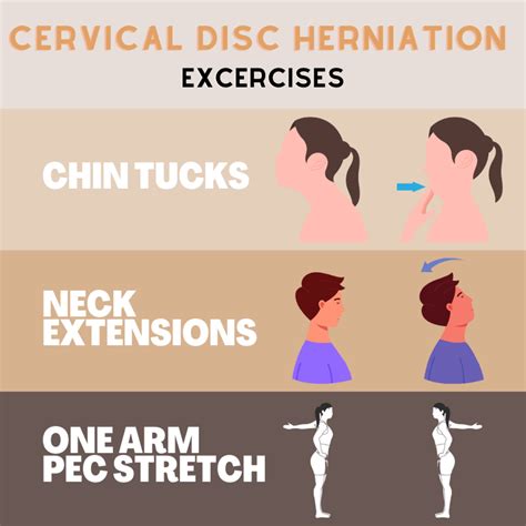 3 Cervical Herniated Disc Exercises – 2465 and friends Physical Therapy Clinic