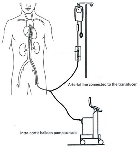 Intra-Aortic Balloon Pump for Patients with Cardiac Conditions: An Update on Available ...
