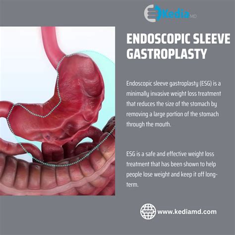 How Much Weight Can You Lose With Endoscopic Sleeve Gastroplasty at Bridget Mireles blog