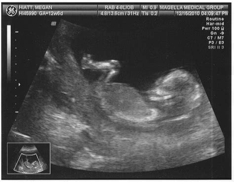 Baby Girl Ultrasound Pictures 13 Weeks at Elizabeth Simson blog