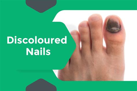 Expert Diagnosis and Treatment for Nail Conditions in Surat