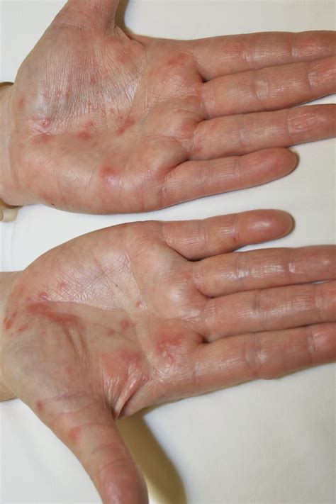skin rashes names - pictures, photos