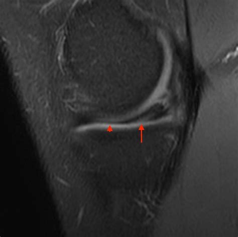 Bucket Handle Tear In Medial Meniscus at Tanya Milford blog