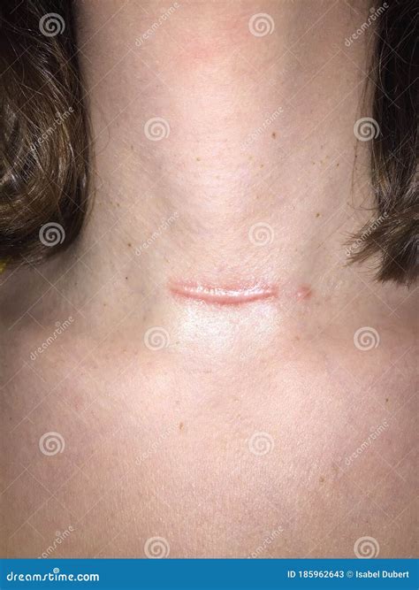 Raised Hypertrophic Scar on Neck after Thyroidectomy Stock Image - Image of caucasian, health ...