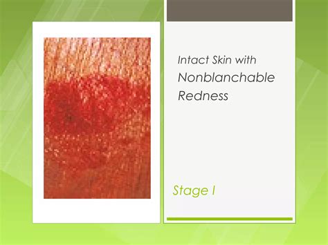 Skin integrity and Wound Care | PPT