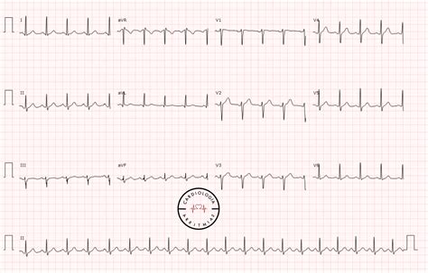 Taquicardia Ventricular Polimórfica / Torsade Pointes 2026
