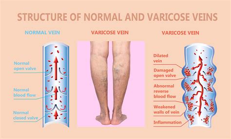 Vein Disorders - Vein Specialists of the Carolinas - "All We Do Is Veins..."