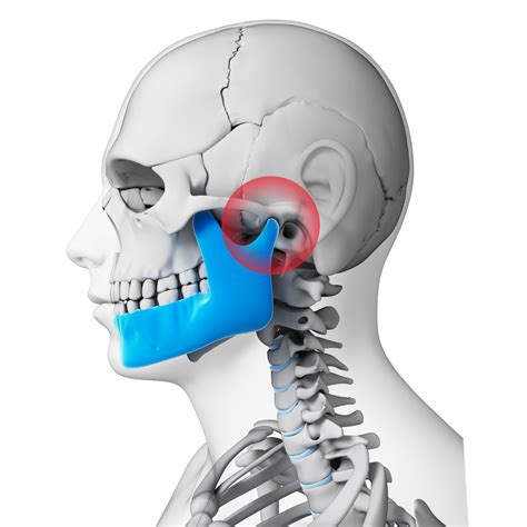 NTI Device for TMJ Disorder - Kansas City, MO - John Goodman, DDS
