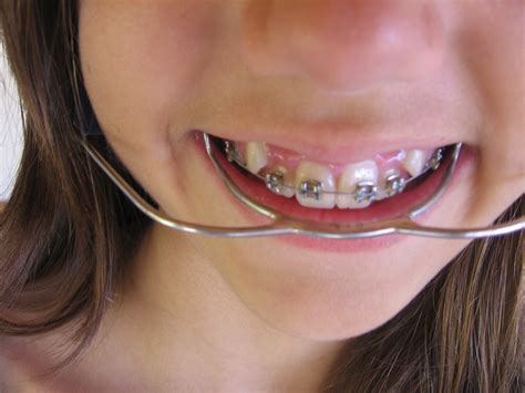 How to Determine Eligibility for Orthodontic Treatment through Medicaid ...