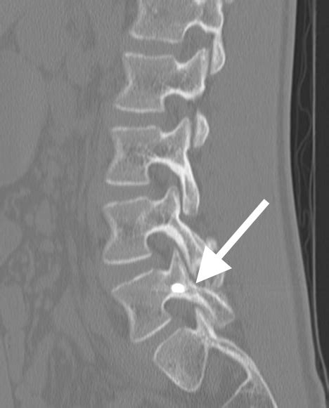Kuvatulokset haulle pars fracture treatment
