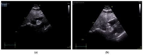 Importance of Multimodality Cardiac Imaging in the Diagnosis of ...