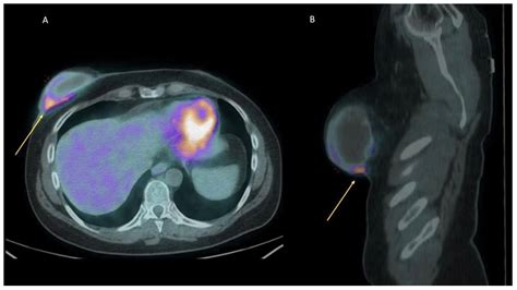 Medical Imaging of Inflammations and Infections of Breast Implants