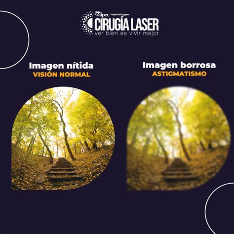 Que Es Astigmatismo