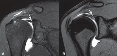 Mri Shoulder Labrum Tear