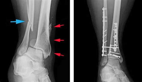 Spiral fracture of tibia and fibula recovery time - blQas