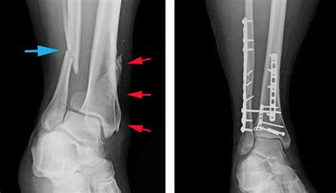 Tibial shaft fracture causes, types, symptoms, diagnosis, treatment ...