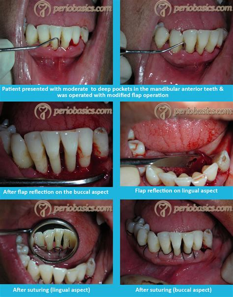 Periodontal Pocket Procedures at Louise Rizo blog