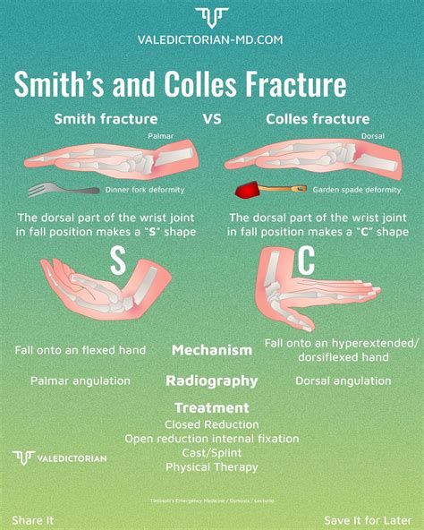 Smith Vs Colles Fracture