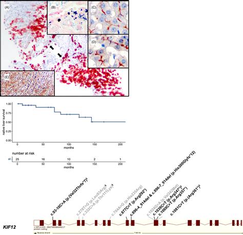 Kinesin family member 12‐related hepatopathy: A generally indolent disorder with elevated gamma ...