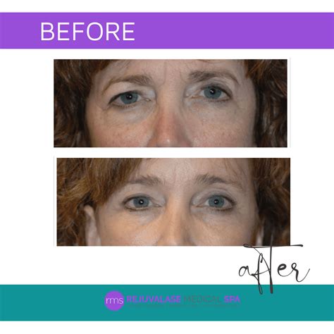 The Endoscopic Brow Lift Invented by Dr. Gregory Keller: A Game-Changer ...