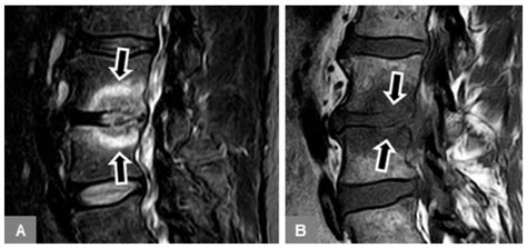 Vertebral Bone Marrow and Endplate Assessment on MR Imaging for the Differentiation of Modic ...