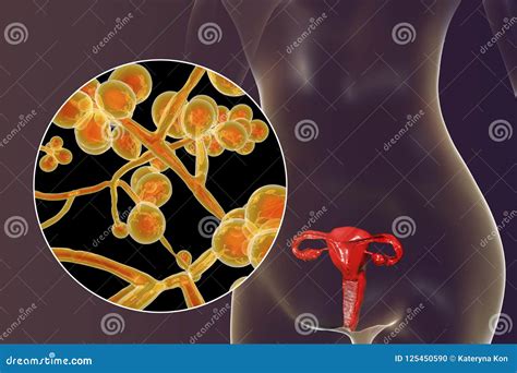 Vaginal Thrush, Female Candidiasis Stock Illustration | CartoonDealer ...