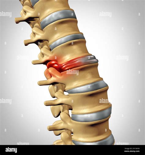 Herniated Disk Spine Disorders as slipped or ruptured disks resulting in back pain concept as a ...