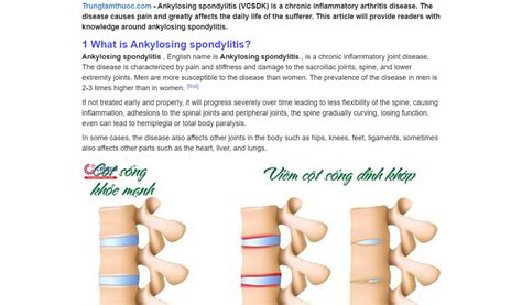 Ankylosing Spondylitis - Causes, Symptoms, Treatment - App on Amazon ...