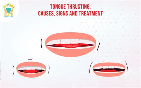 What Is A Tongue Thrust