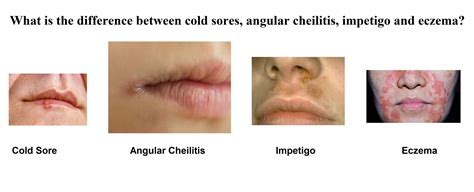 Cold Sore Or Angular Cheilitis