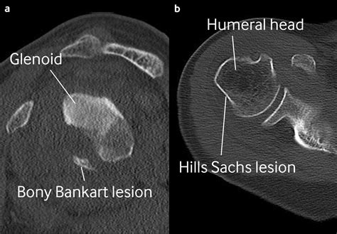 Bony lesions after anterior shoulder dislocation | The BMJ