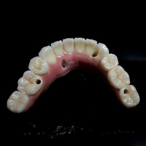 ALL-ON-FOUR LOWER IMPLANT BRIDGE - ALL CERAMIC - Northland ...