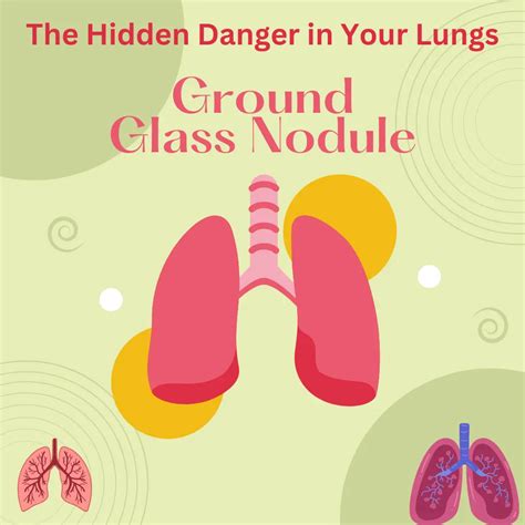 Ground Glass Nodule: The Hidden Danger in Your Lungs | HealthFness