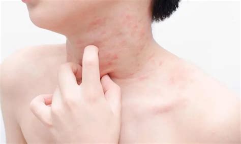 Rilzabrutinib could be effective treatment option in individuals with ...