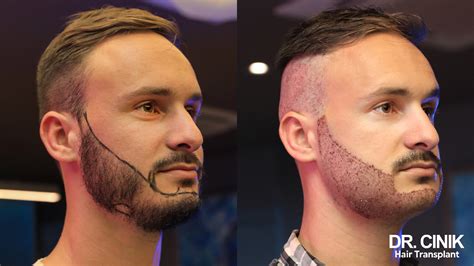 Facial Hair Transplant Recovery Time at Harvey Rosas blog