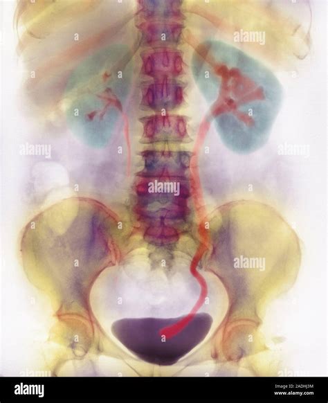 Kidney stone in ureter. Coloured urogram (X-ray) of a patient's abdomen ...