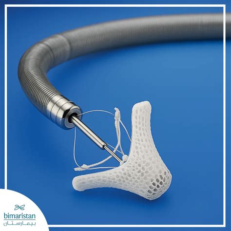 MitraClip Procedure: A Minimally Invasive Solution for Mitral Valve Regurgitation - بيمارستان